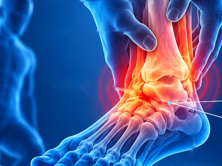 Ilustrasi pergelangan kaki keseleo dengan ligamen robek atau teregang
